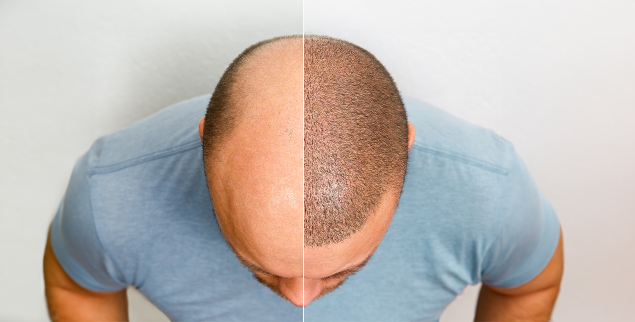 Hair Transplant