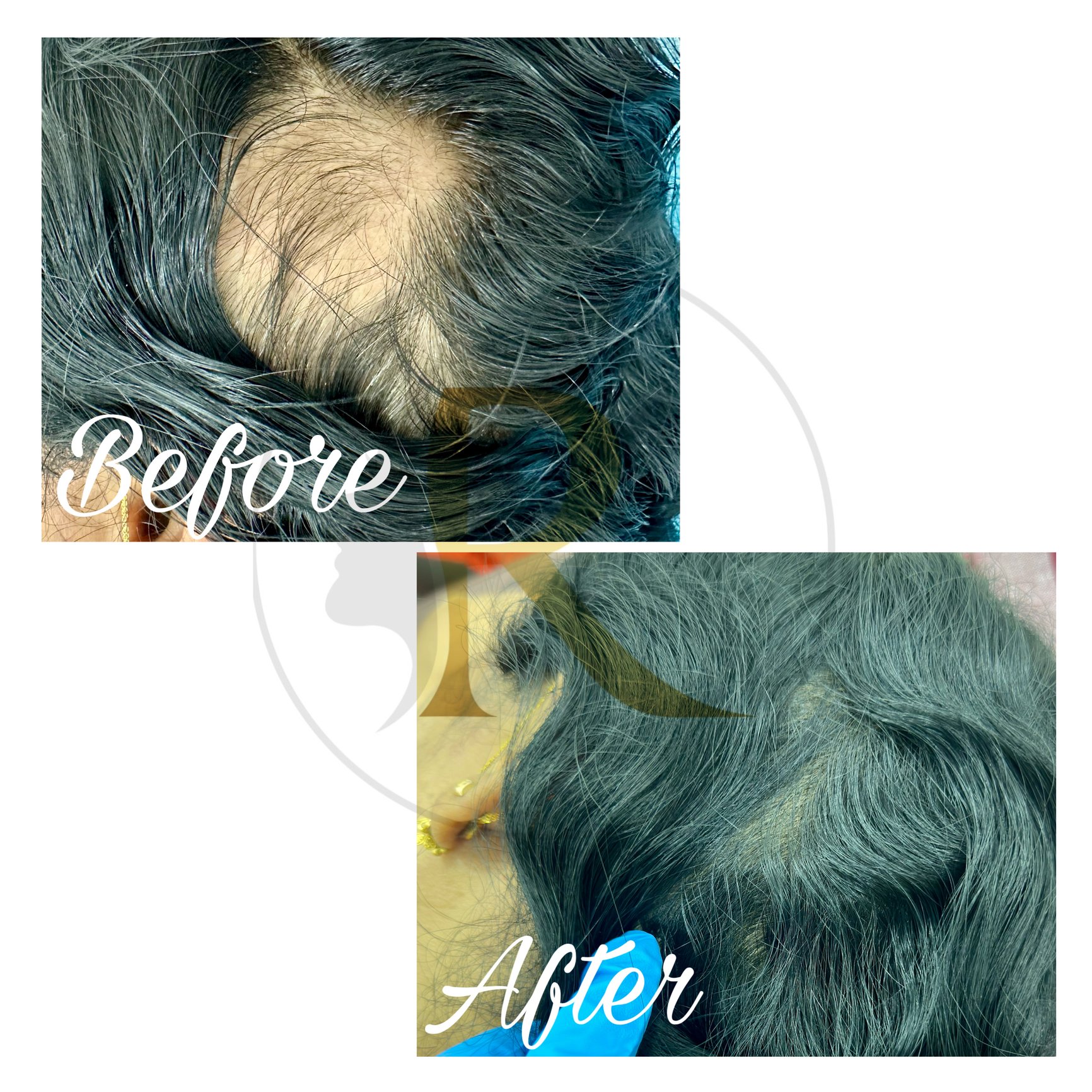 Alopecia Aerata Treatment