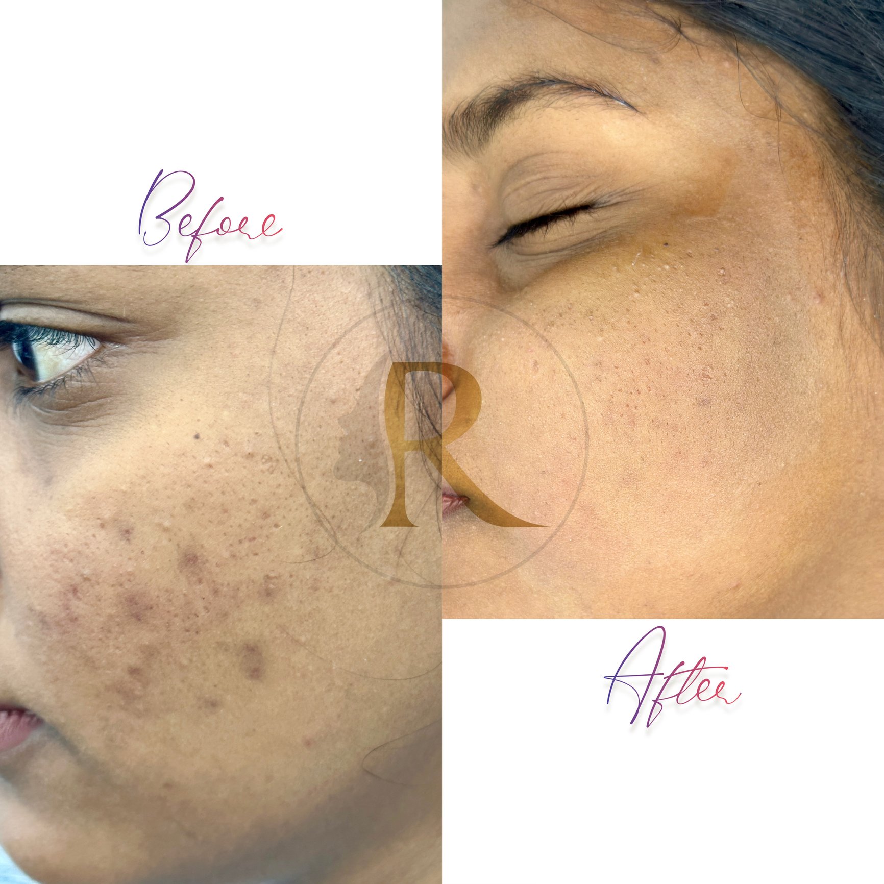 Black Spots Treatment