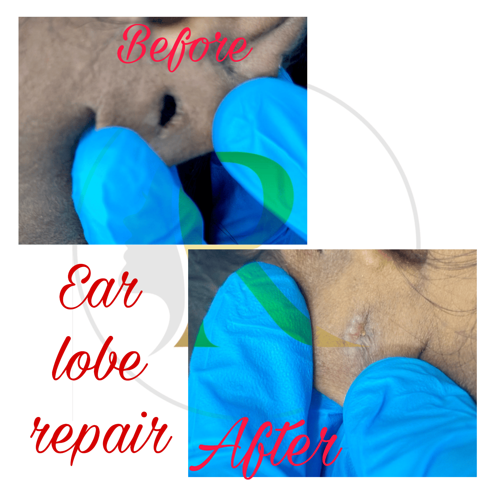 Ear Lobe Repair