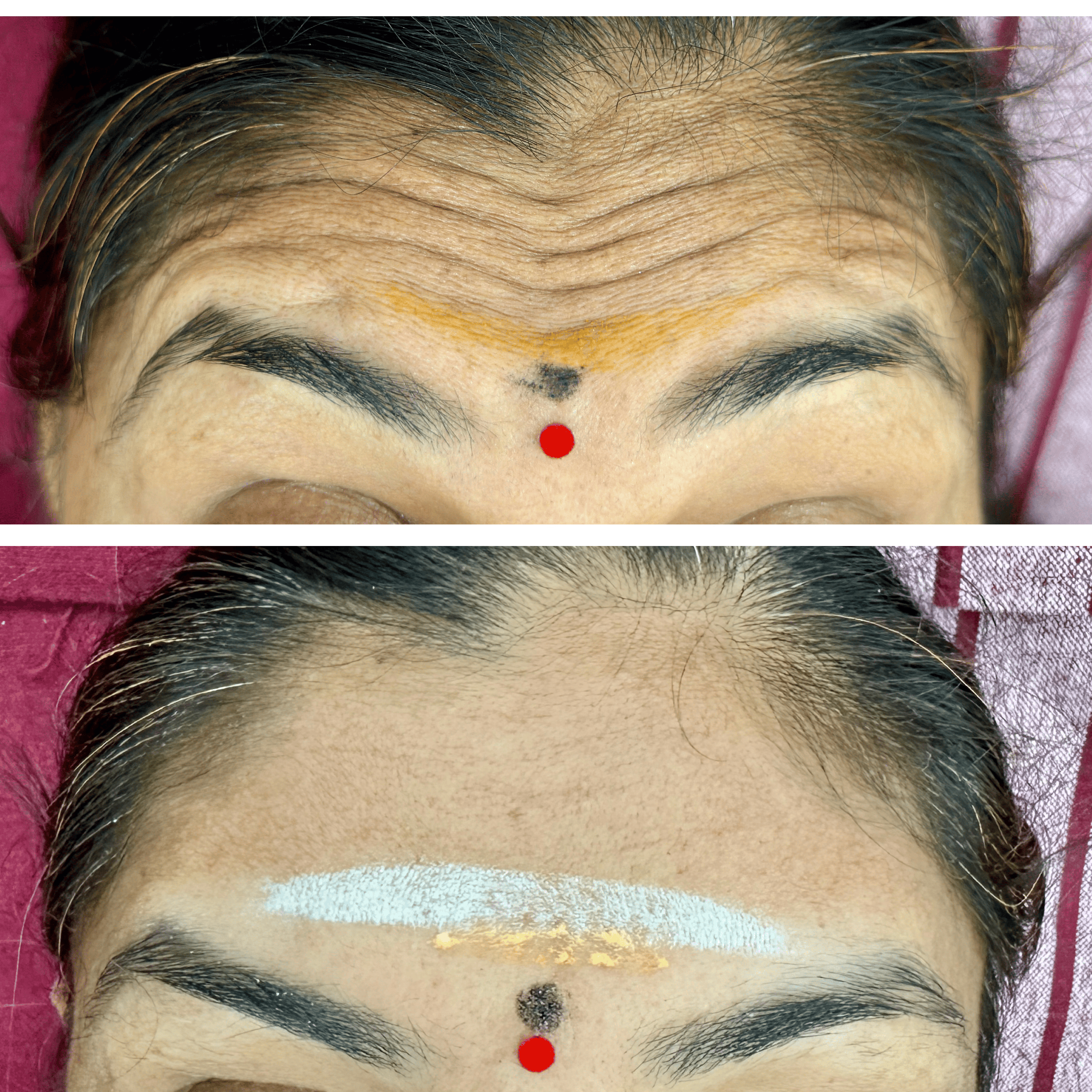 Forehead Lines Botox