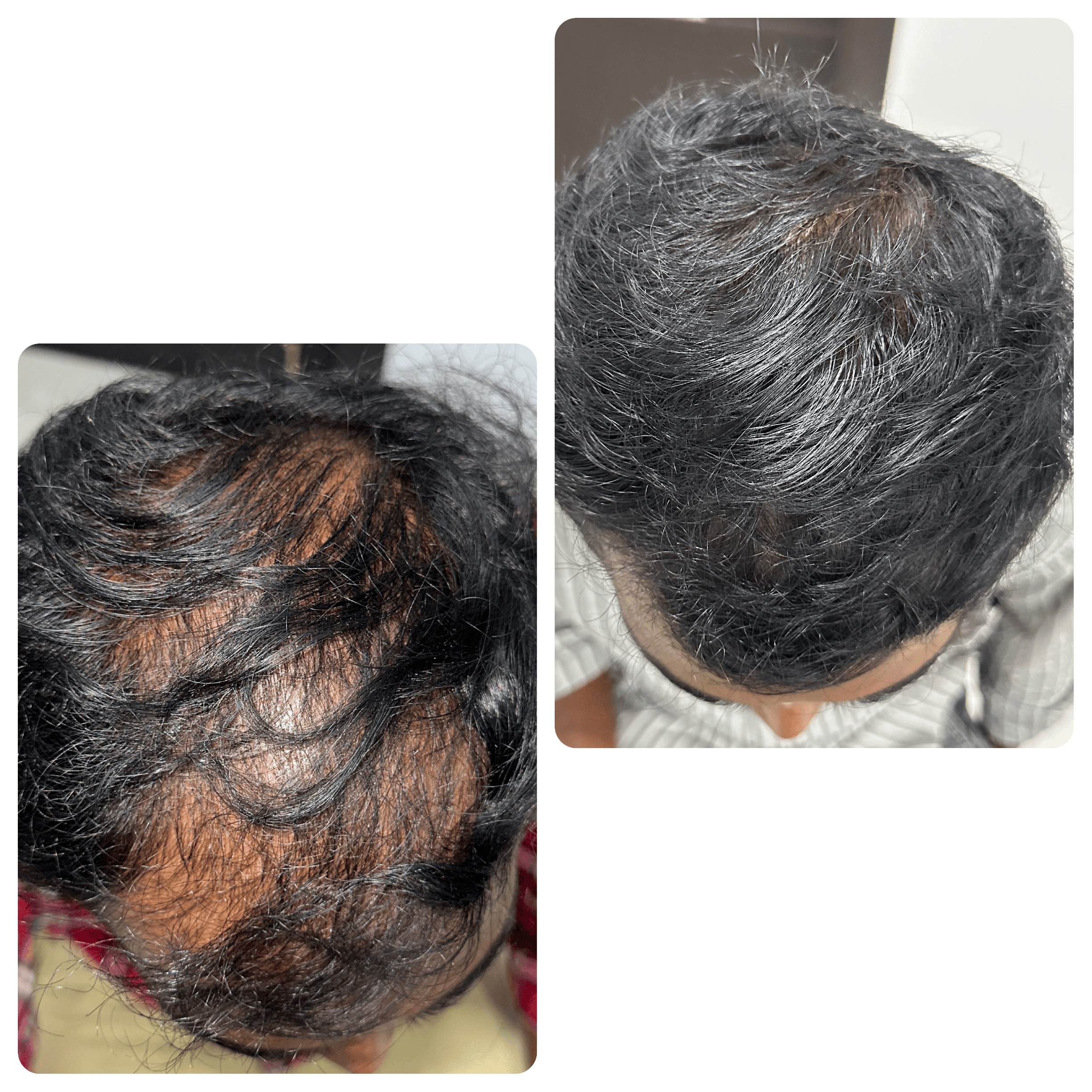 Male Pattern Hairloss