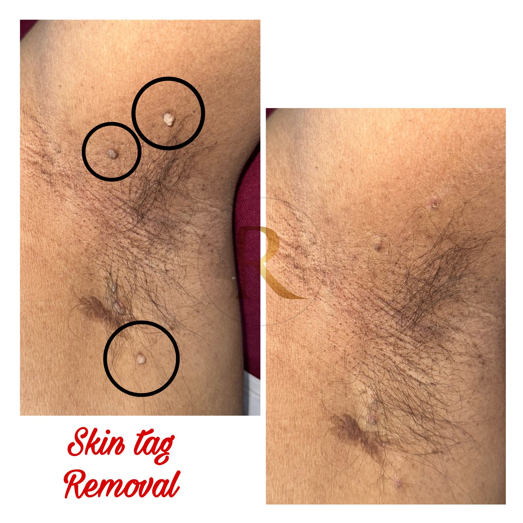 Skin Tag Removal